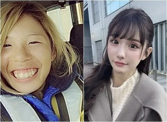 2억원치 성형결과 이미지 2